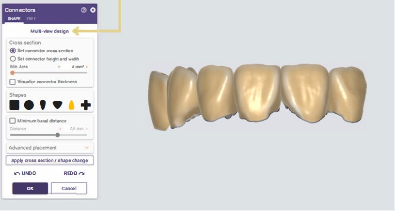 Exocad tip 2 - Multi-View Design – 3D Openminds