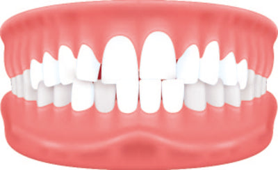 Tanden te dicht op elkaar